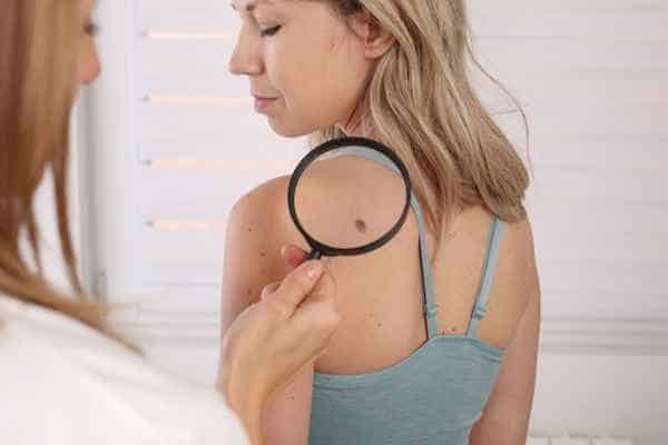What Are Traditional Skin Lesion Removal Methods Eastbourne?