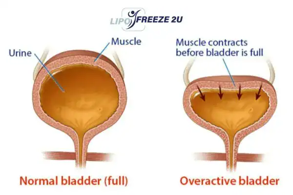 diagram of overactive bladder treatment Eastbourne