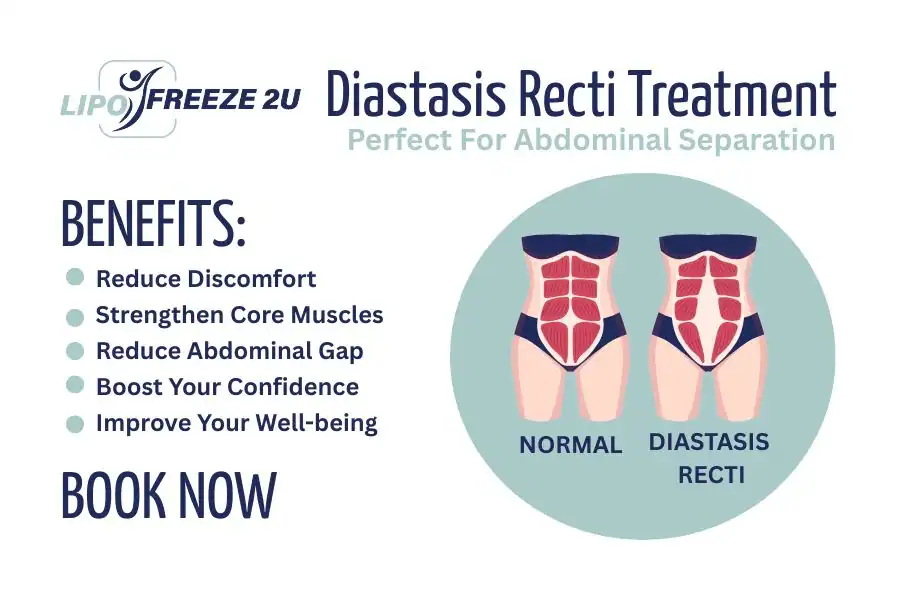 Benefits of body toning treatment Eastbourne for Diastasis recti