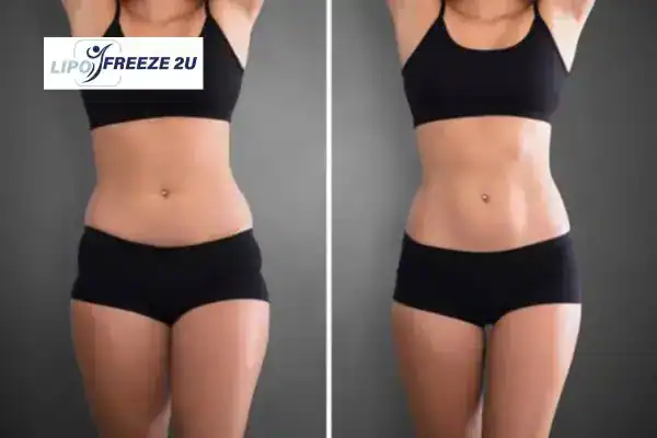 How Can LIPO FREEZE 2U Support Your Post-Pregnancy Body Recovery Eastbourne?