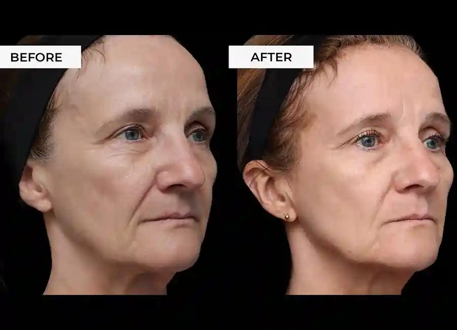 How Many RF Microneedling Sessions Will You Need to See a Difference Eastbourne?