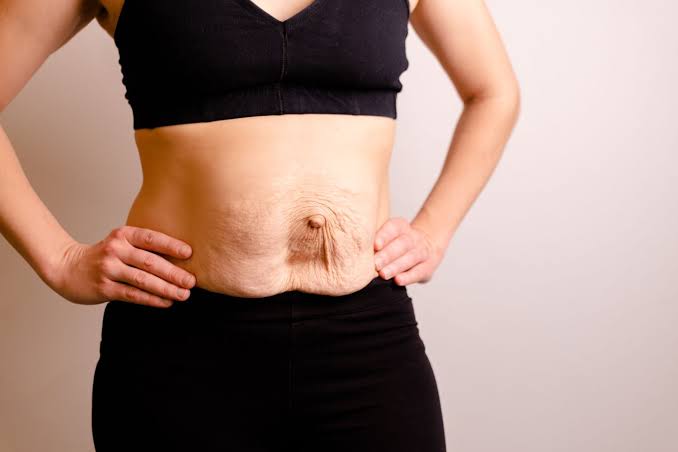 Is Surgery Really the Only Way to Repair Diastasis Recti Eastbourne?
