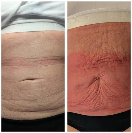 How Does RF Microneedling Improve Crepey, Thin and Uneven Skin Texture Eastbourne?