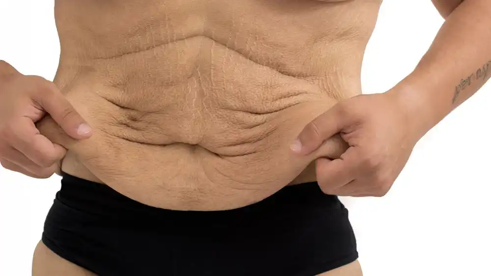 Why Does Weight Loss Medication Leave Some People With Loose or Sagging Skin Eastbourne?